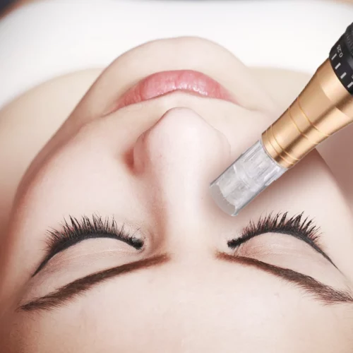 microneedling