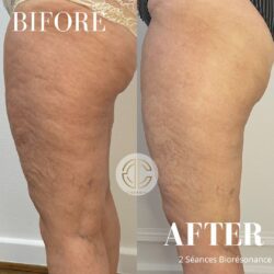 photo avant après 2 séance biorésonance cuisses