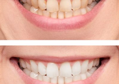 avant après blanchiment dents
