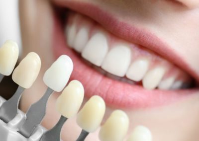 Blanchiment dentaire