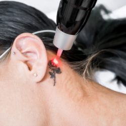 détatouage derrière l'oreille