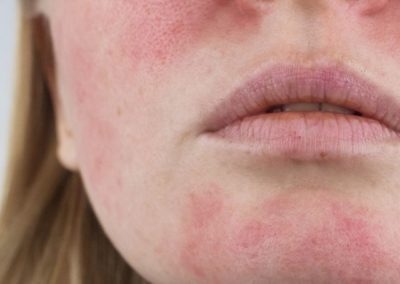 Traitement Couperose