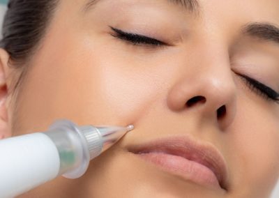 plasma froid, plasma lift