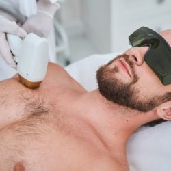 laser dépilation homme