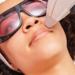 depilation levres sup