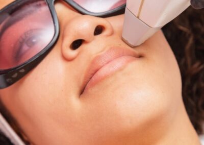 depilation levres sup