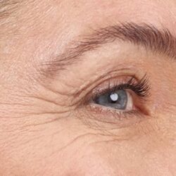 plasma froid pattes d'oie