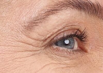 plasma froid pattes d'oie