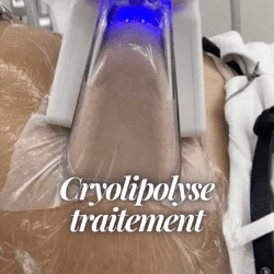 Cryolipolyse chez cdermyl