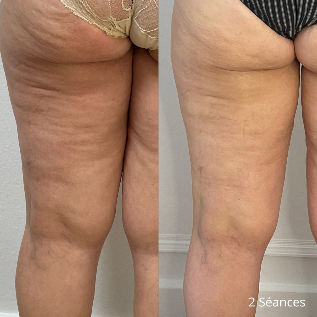 Avant Après lipocell advance Avant Après lipocell advance