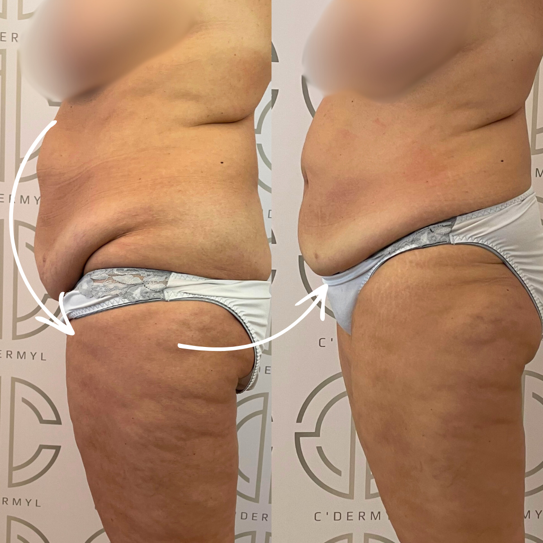 Avant Après lipocell advance Avant Après lipocell advance