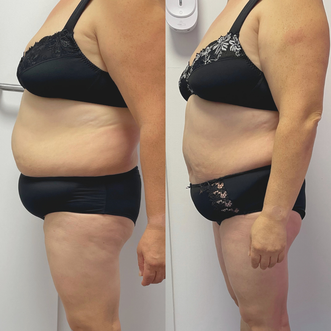 Avant Après lipocell advance Avant Après lipocell advance