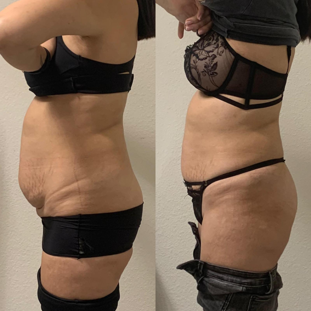 Avant Après lipocell advance Avant Après lipocell advance