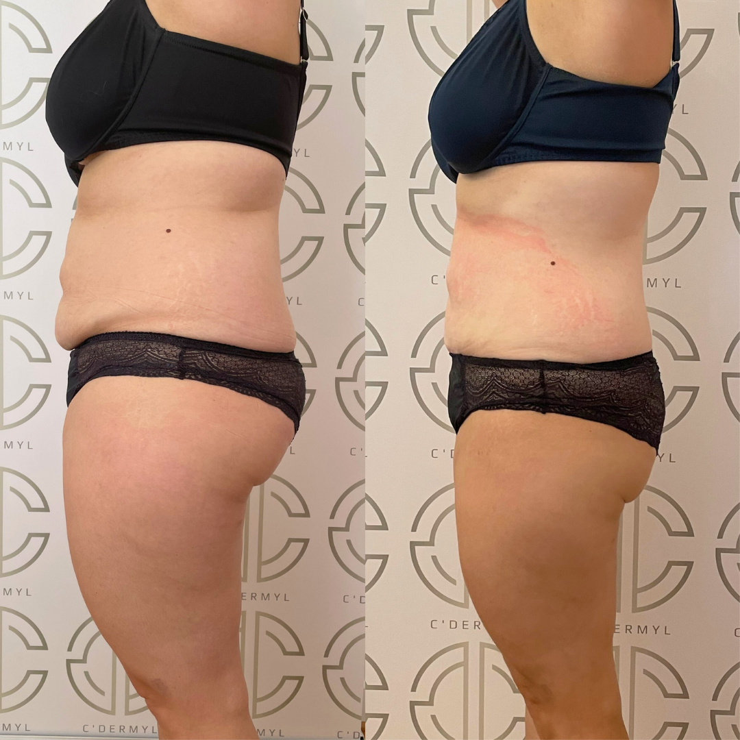 Avant Après lipocell advance Avant Après lipocell advance