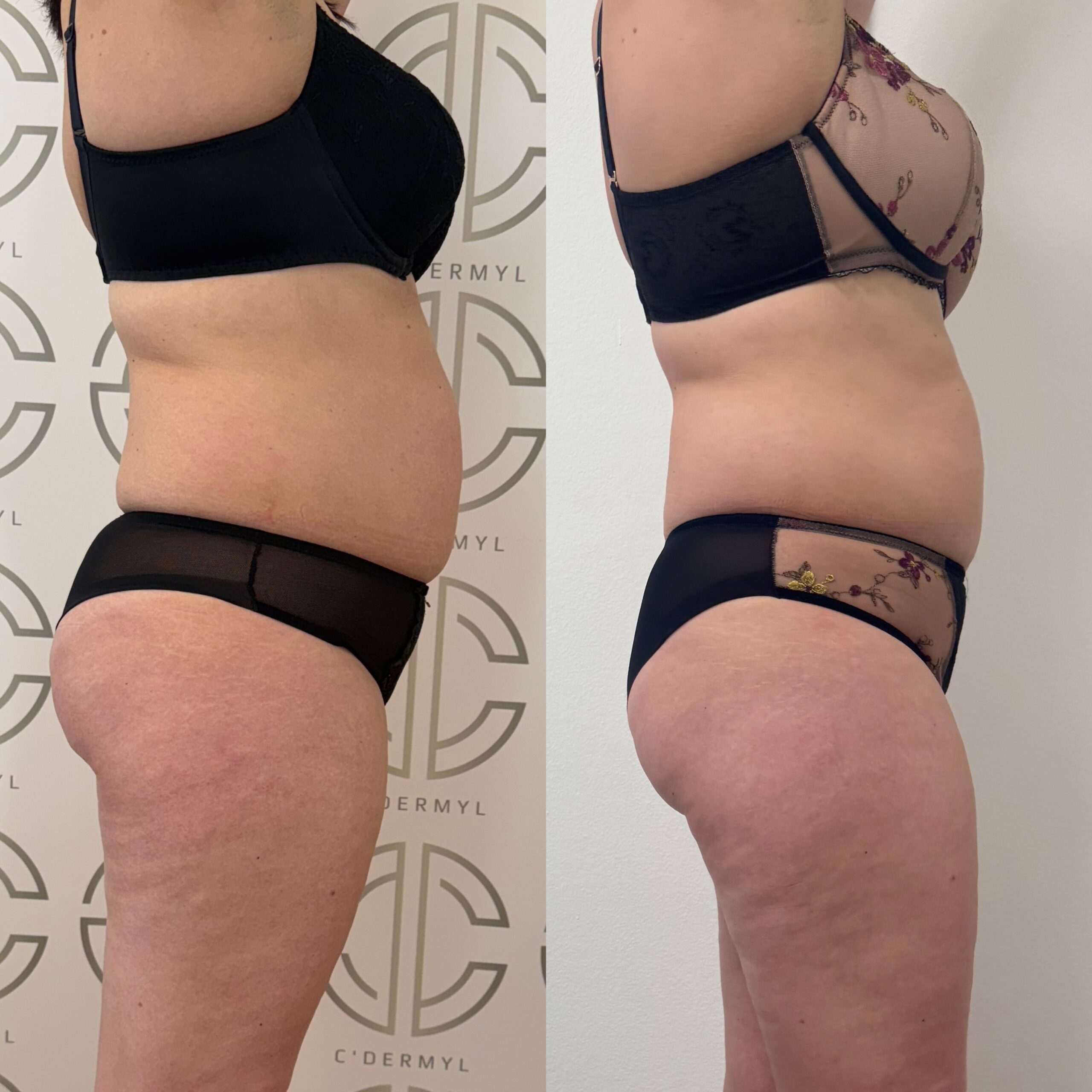 Avant Après lipocell advance Avant Après lipocell advance