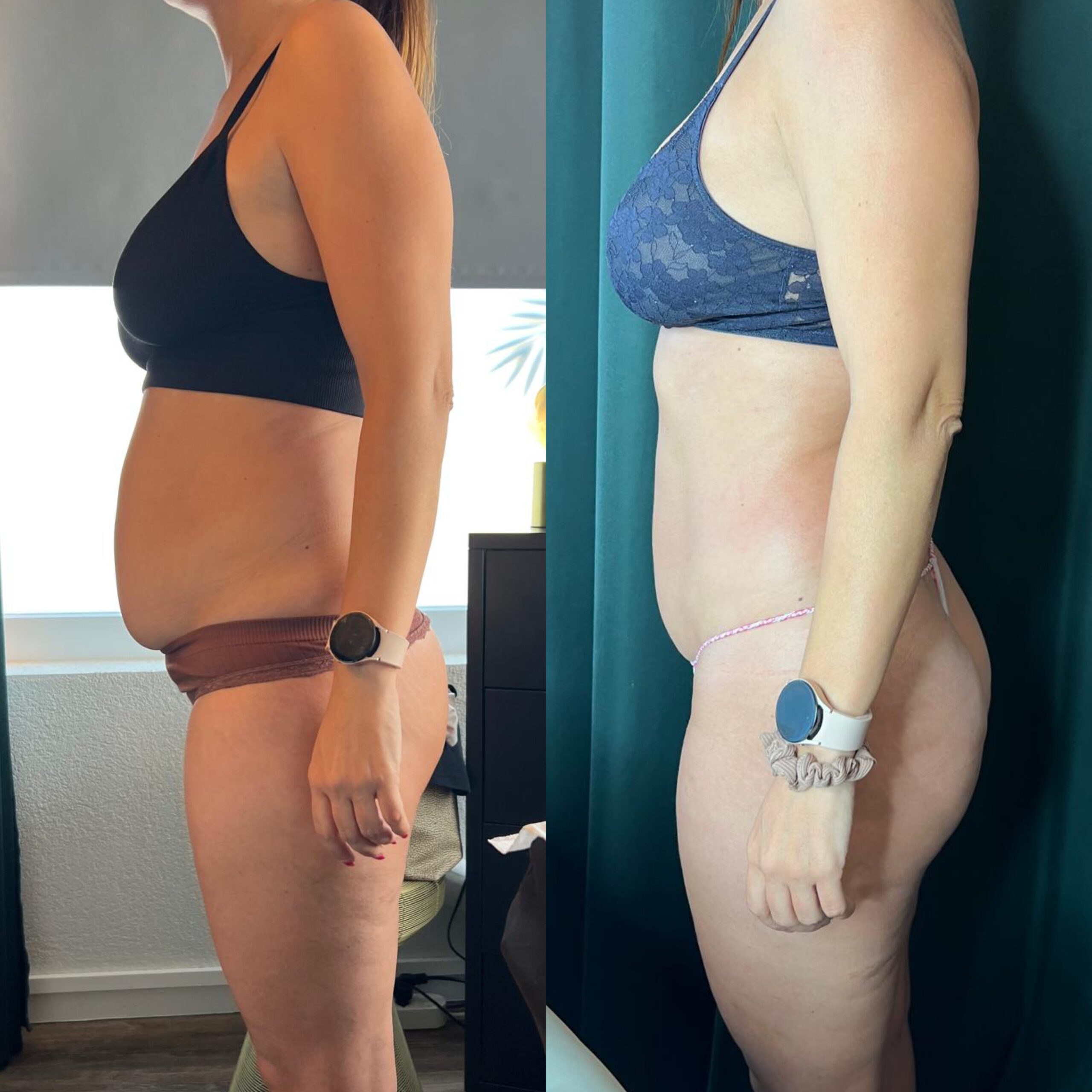 Avant Après lipocell advance Avant Après lipocell advance