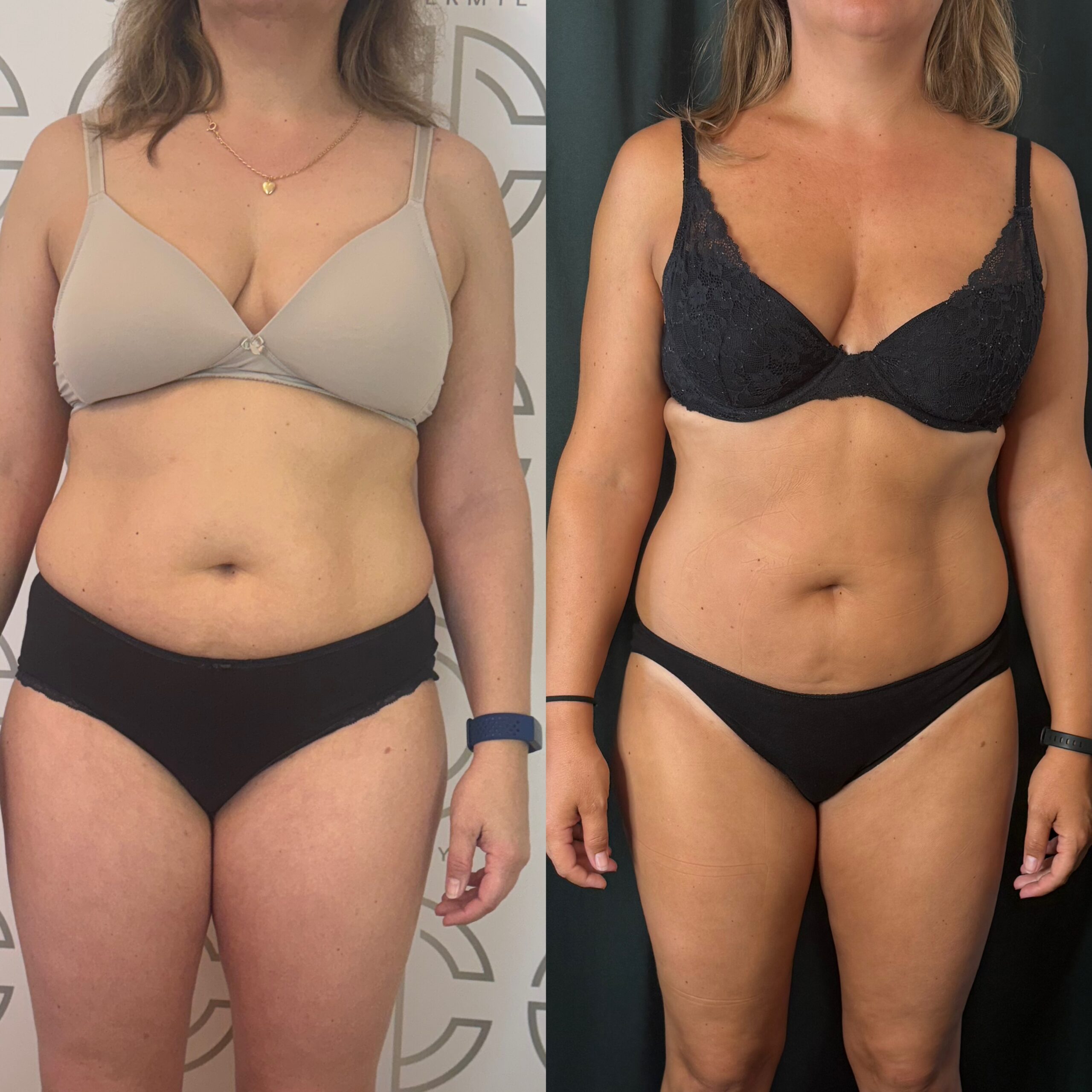 Avant Après lipocell advance Avant Après lipocell advance