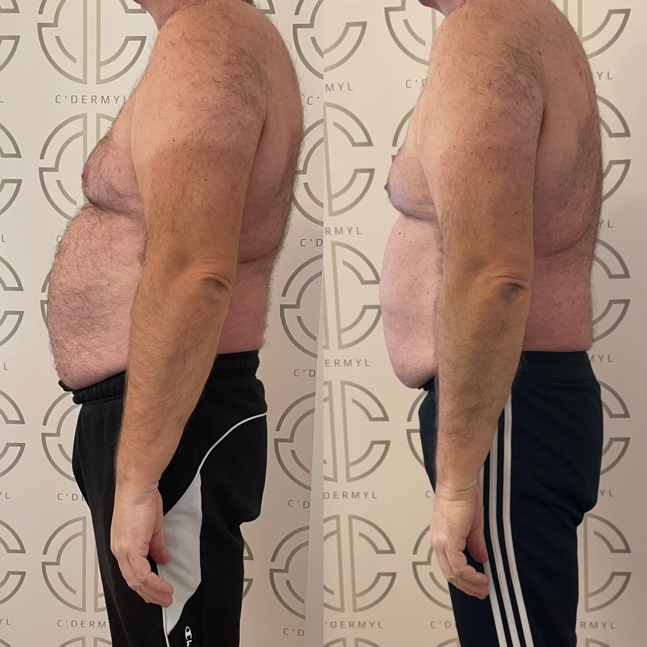 Avant Après lipocell advance avant après traitement cellulite cuisses