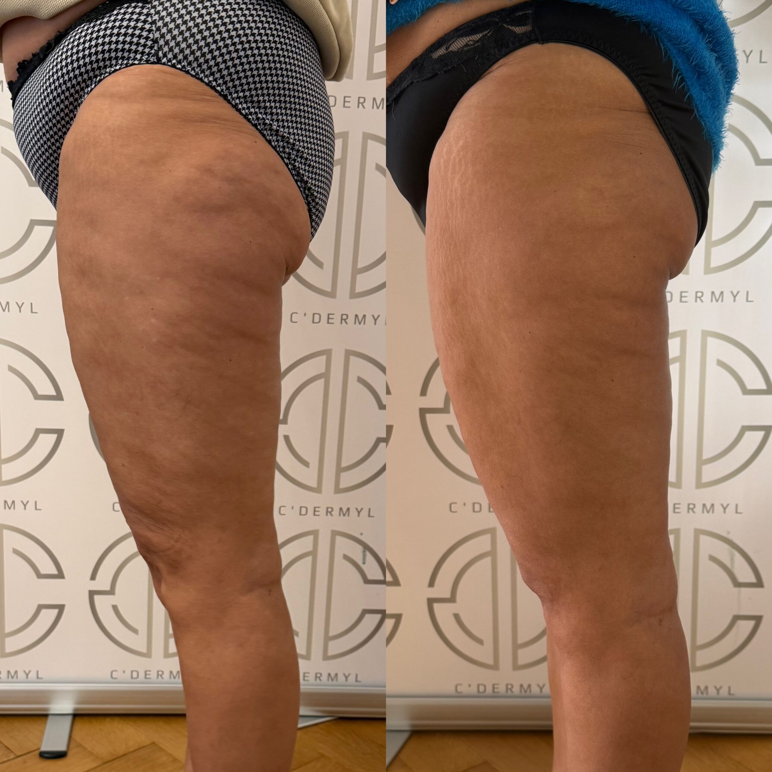 Avant Après lipocell advance Avant Après lipocell advance