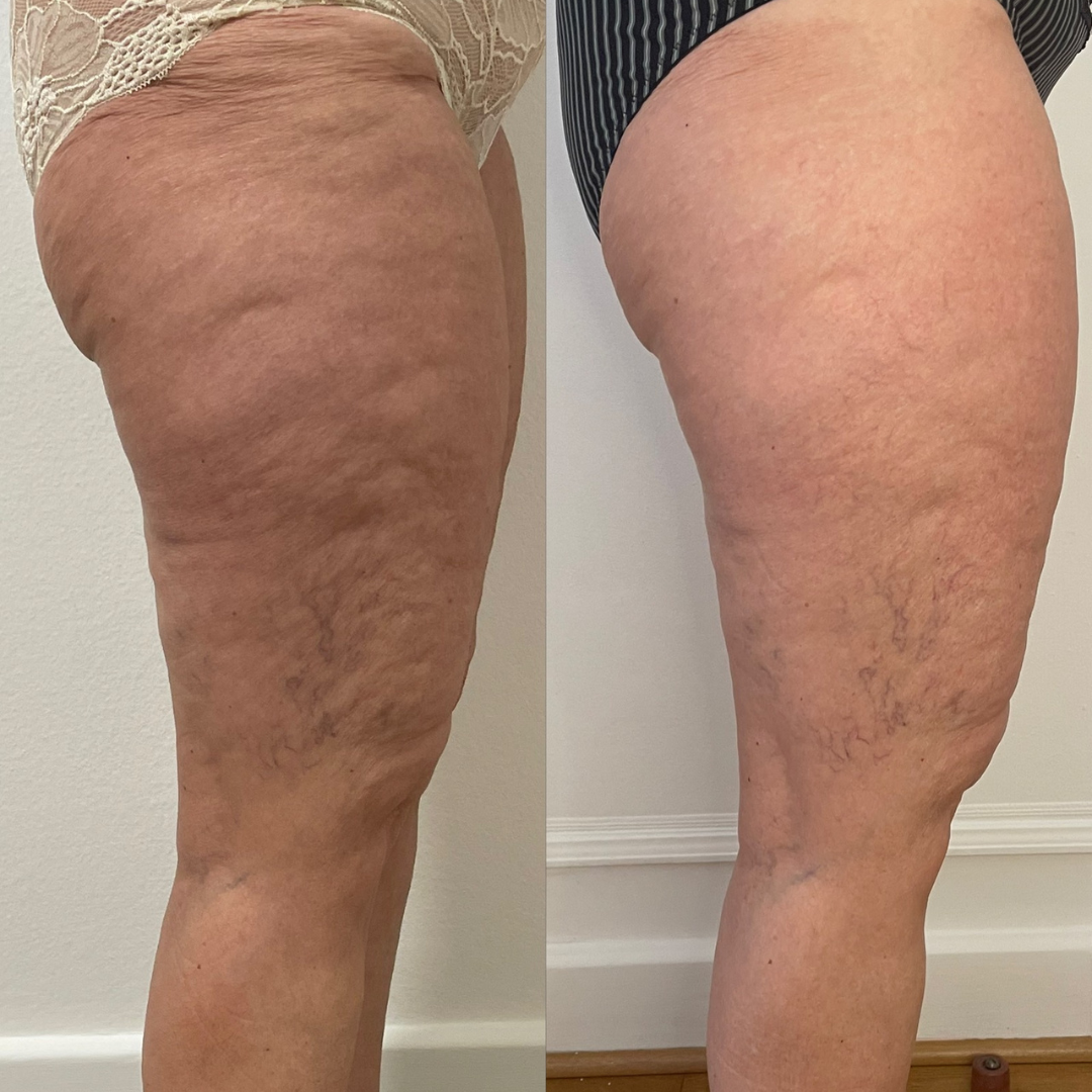 Avant Après lipocell advance Avant Après lipocell advance
