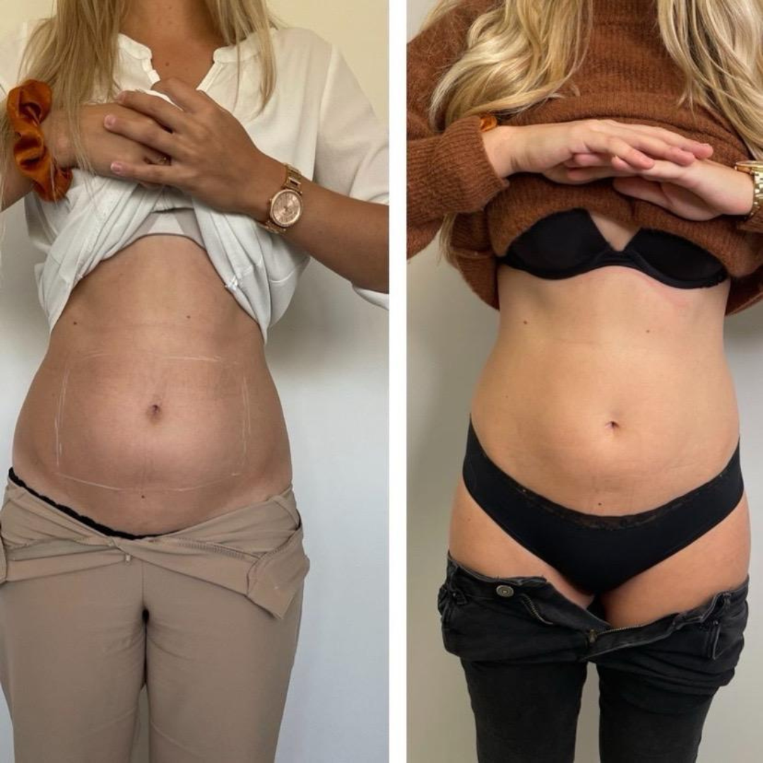 Avant Après lipocell advance Avant Après lipocell advance